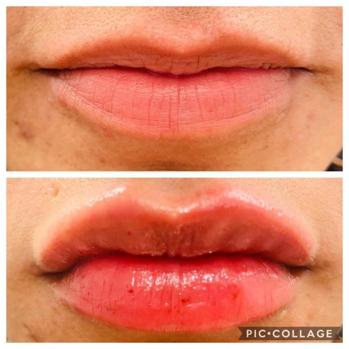 Hyaluronic Acid Dermal Filler With Lidocaine Injectable Wrinkle Fillers