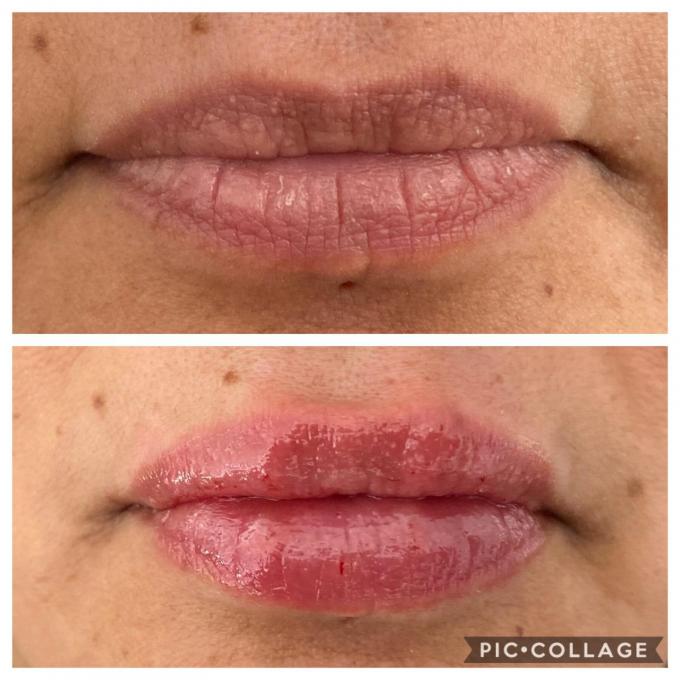 Hyaluronic Acid Dermal Filler With Lidocaine Injectable Wrinkle Fillers