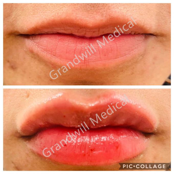 Augmmentation Hyaluronic Acid Lip Injections Natural Looking Plump Lip