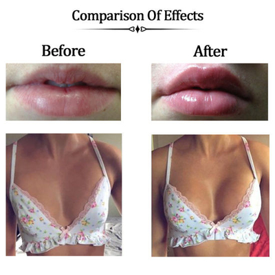 Natural Looking Lip Fillers Injectable Hyaluronic Acid Breast Buttocks Body Filler