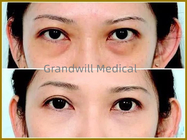 Injectable Sodium Hyaluronate Composite Solution Remove Dark Circles Fill Tear Groove