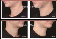 Hospital Neck Lines 1ml Hyaluronic Acid Filler Removing Neck Fine Wrinkles