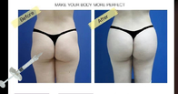 Subskin SubQ Injectable Hyaluronic Acid Breast Filler For Buttock Penis Augmentation
