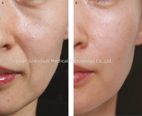 PCL Cross Linked Hyaluronic Acid Dermal Filler Polycaprolactone