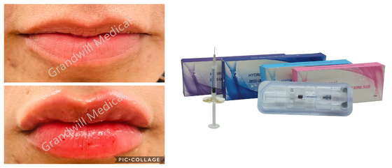 Injectable Hyaluronic Acid Dermal Filler 1ml 2ml 3ml 5ml 10ml 20ml 50ml For Breast Buttocks Body