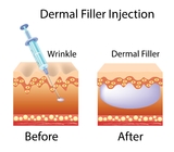 Hyaluronic Acid Filler Manufacturer Injectable Modified Sodium Hyaluronate Gel For Face Body