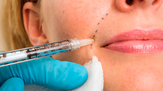 Collagen Stimulating PCL Dermal Filler Gel Hyaluronic Acid with CMC Anti Wrinkle