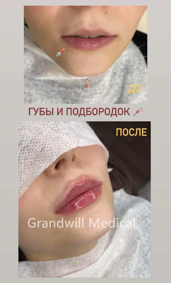 24mg/ml Injectable Hyaluronic Acid Dermal Filler For Wrinkle Smoothing