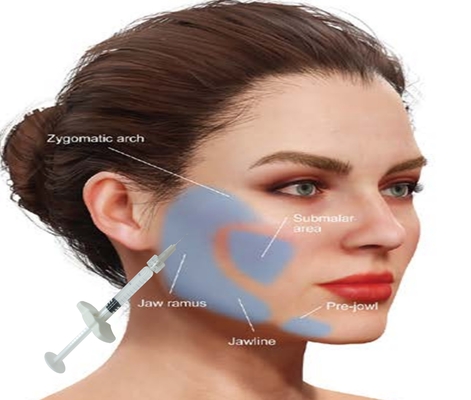 Hyaluronic Acid HA Calcium Hydroxyapatite Filler Get Natural Looking Face With 1ML Syringe