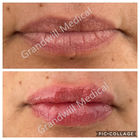 Gel Form Injectable Lip Fillers 24mg/Ml Hyaluronic Acid Natural