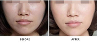 2ml 2.5ml Non Cross Linked HA Dermal Filler For Skin Lightening Face Anti Aging