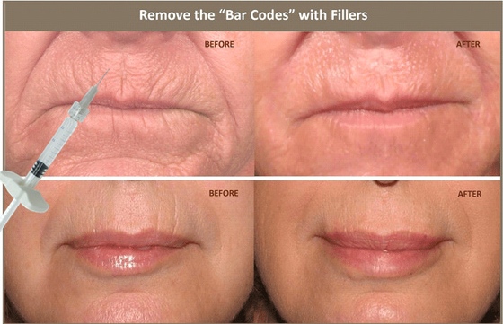 10ml Injectable Hyaluronic Acid Dermal Filler For Correcting Facial Asymmetry