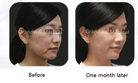 Polycaprolactone Dermal Filler Collagen Stimulator For Facial Wrinkles Treatment
