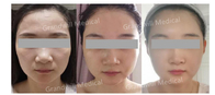Face Lift HA PCL Dermal Filler Miracle Touch Up Microneedling Injection