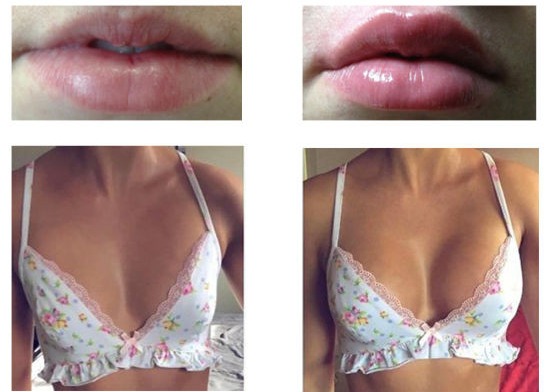 Breast Enlargement Injection Filler Hyaluronic Acid Implant Lip Injections Dermal Filler