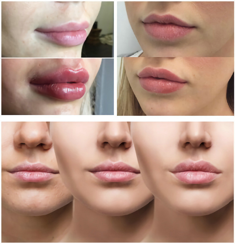 Smooth Lines / Plump Lips With Hyaluronic Acid Injectable Filler 1ml 2ml 5ml