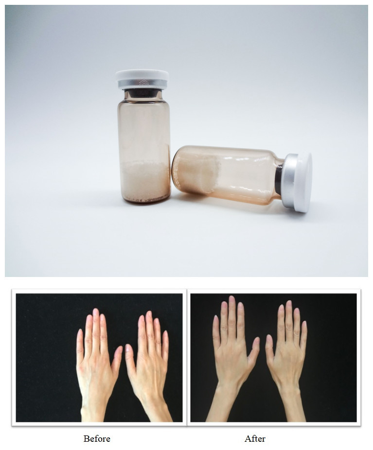 Sterile Facial Dermal Fillers PLLA Hyaluronic Acid Injectable Gel Designed for Smooth Wrinkle Correction and Facial Volume Restoration