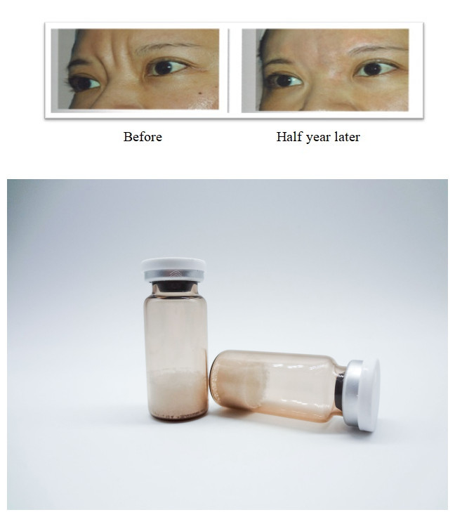 Non Animal Injectable Gel Facial Dermal Fillers Hyaluronic Acid Based for Safe Wrinkle Treatment and Volume Restoration