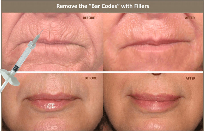 10ml Injectable Hyaluronic Acid Dermal Filler For Correcting Facial Asymmetry
