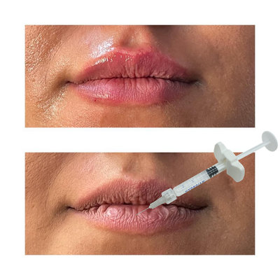 Non Surgical Lip Enhancement Fillers Hyaluronic Acid Lip Injections