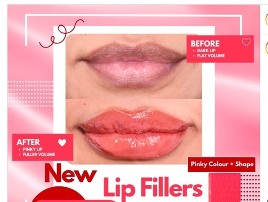 Enhance Your Lips With RED Patented Lip Filler Safe And Effective Lip Augmentation